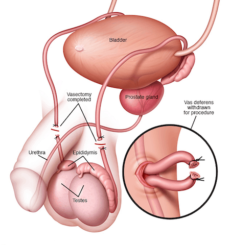 Cirujano Urologo Especialista en Vasectomia en Mexico 001