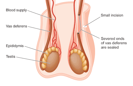 Cirujano Urologo Especialista en Vasectomia en Mexico 001