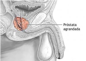 Cirujano Urologo en Mexico Dr Patricio Cruz Garcia Cirugia de Prostata por Crecimiento Benigno v001