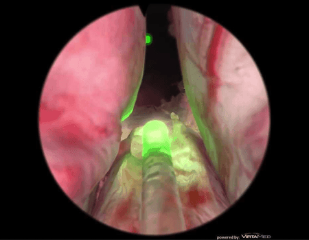 Cirujano Urologo en Mexico Dr Patricio Cruz Garcia Cirugia de Prostata por Crecimiento Benigno v003 compressor