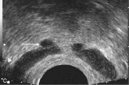 Cirujano Urologo en Mexico Especialista en Biopsia de Prostata