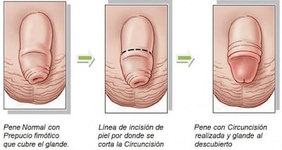 Cirujano Urologo en Mexico Especialista en Fimosis y Circuncision 002