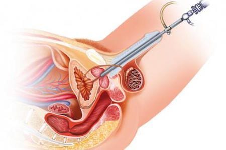 Dr Patricio Cruz Cirujano Urologo especialista en Cistoscopia en Mexico 2