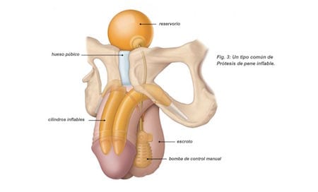 Dr Patricio Cruz Cirujano Urologo especialista en Protesis de Pene en Mexico 2