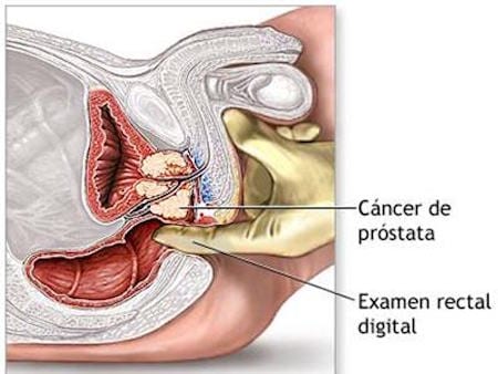 Especialista-en-Urologia-Cancer-de-Prostata-Tacto-Rectal-Cirujano-Urologo-en-Mexico_v001