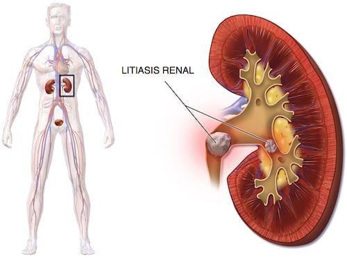 Urologo en Mexico Especialista en Litiasis Renal