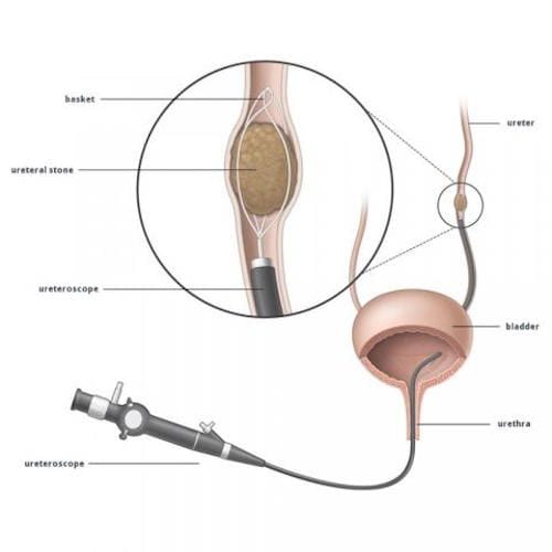 Urologo en Mexico Especialista en Litiasis Ureteral