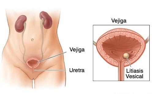 Urologo en Mexico Especialista en Litiasis Vesicular