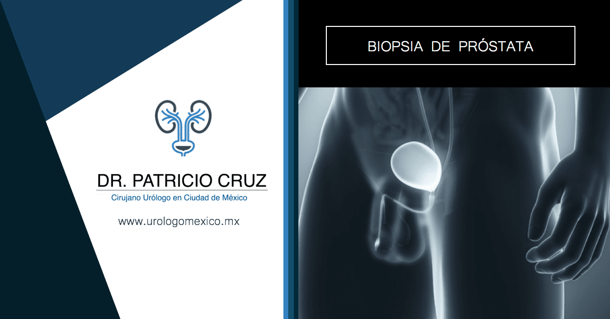 biopsia de próstata para retención urinaria aguda