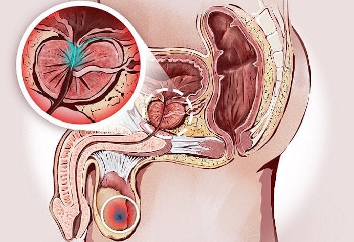 Sintomas-de-Prostata-Inflamada-Cirujano-Urologo-en-Mexico-Dr-Patricio-Cruz-001-compressor