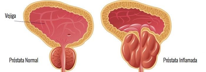 Sintomas-de-Prostata-Inflamada-Cirujano-Urologo-en-Mexico-Dr-Patricio-Cruz-002-compressor