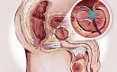 Sintomas-de-Prostata-Inflamada-Cirujano-Urologo-en-Mexico-Dr-Patricio-Cruz-004-compressor