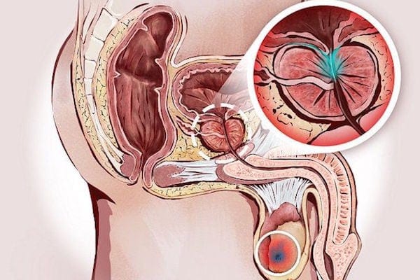 glándula prostática inflamada