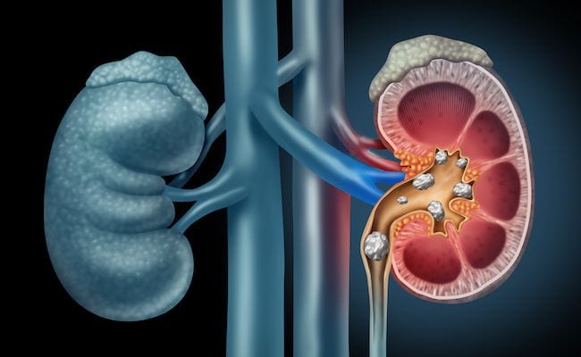 Cirugia-de-Litiasis-Renal-Extraccion-de-Calculos-Renales-urologo-en-mexico-v002-compressor