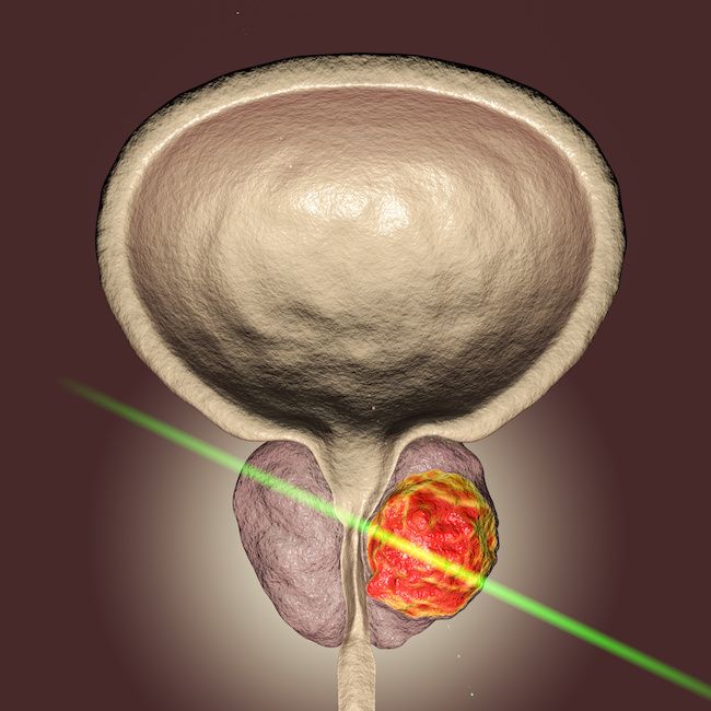 El-Laser-en-la-Urologia-v001-compressor