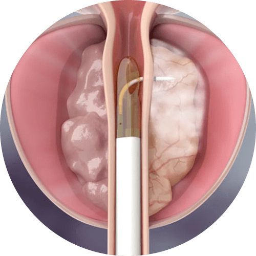 Urologo en Mexico especialista en Tratamiento REZUM v001