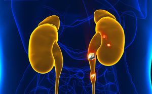 Piedras en el Riñón | Causas, Síntomas y Tratamiento